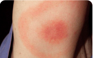 bullseye rash associated with Lyme disease